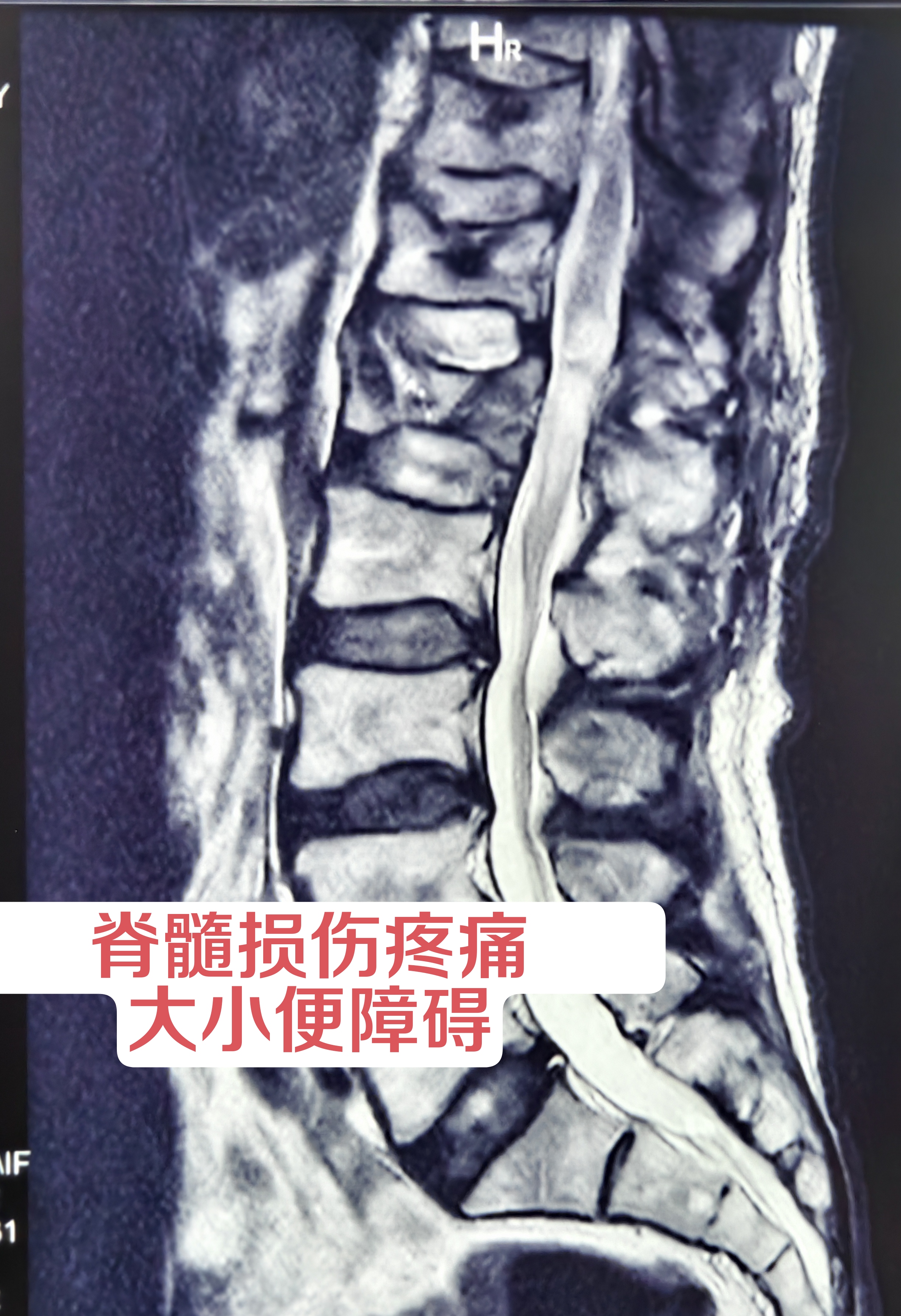 包含哈里伯顿右小腿拉伤将进行核磁检查G6出战成疑的词条
